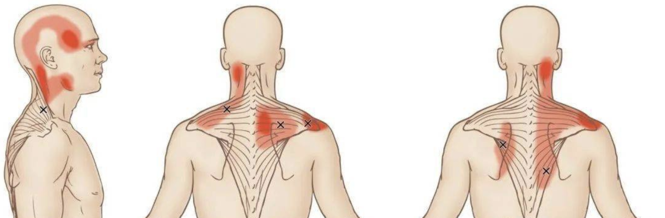 What causes pain from neck to shoulder
